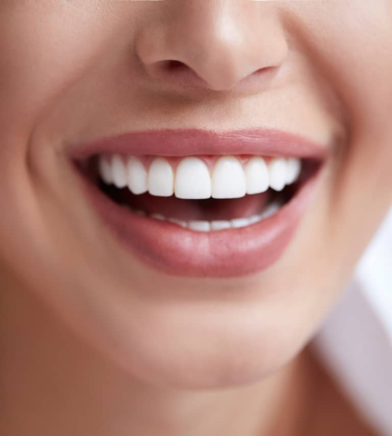 Dental Veeners Smile Design