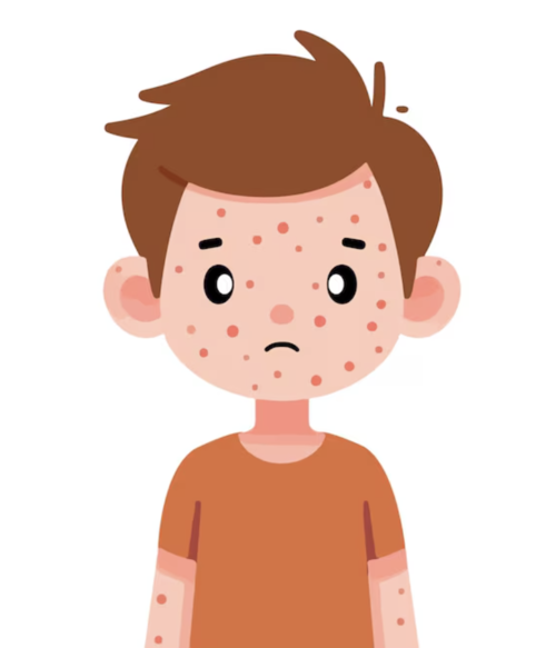 niño con brote de sarampión