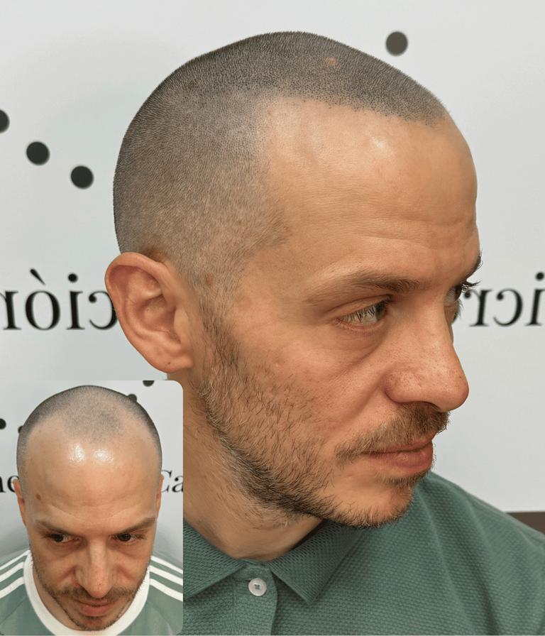 Micropigmentación Capilar en Madrid efecto rapado