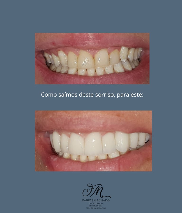 Mudança no sorriso, com planejamento de facetas em Curitiba no Bairro Batel.
