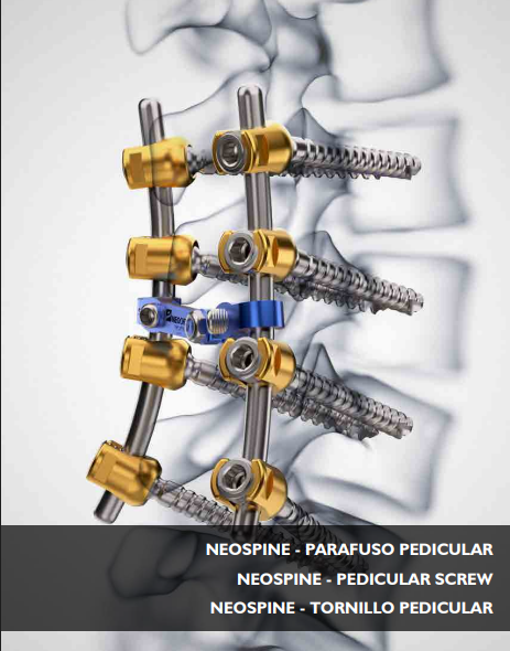 Neospine pedicular screw system for spinal stabilization surgery on human vertebrae.