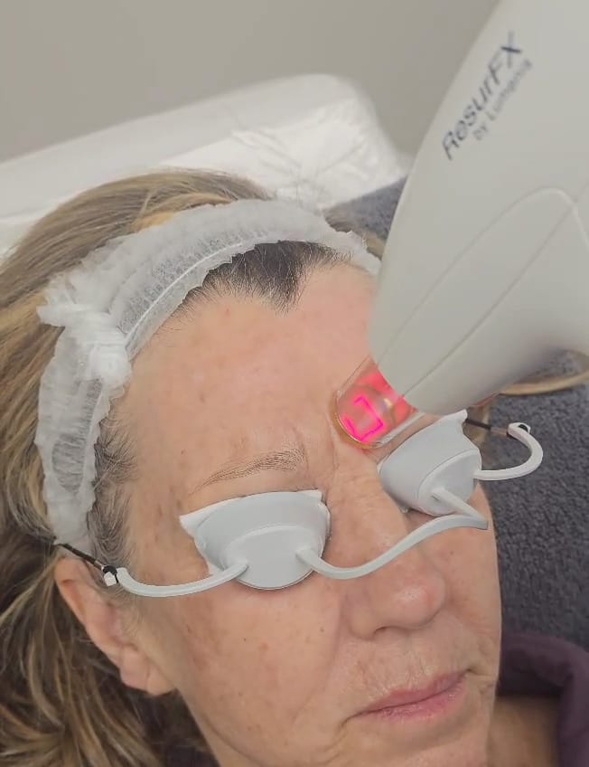ResurFX treatment for a woman at Ariana Esthetic Edmonton