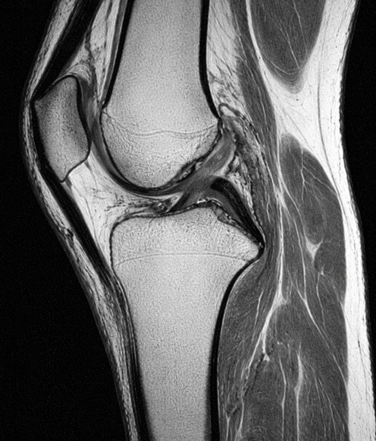 IRM genou menisque ligament