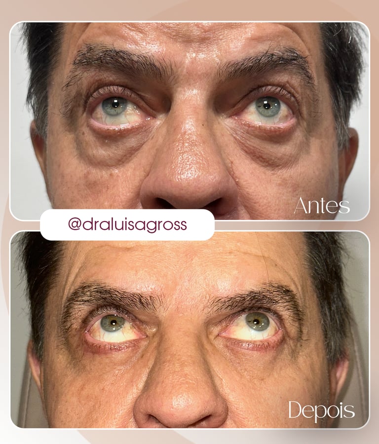 Antes e depois de cirurgia periocular realizada pela Dra. Luisa Gross
