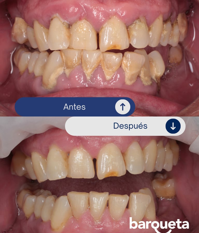 resultados de una limpieza dental profesional en sevilla
