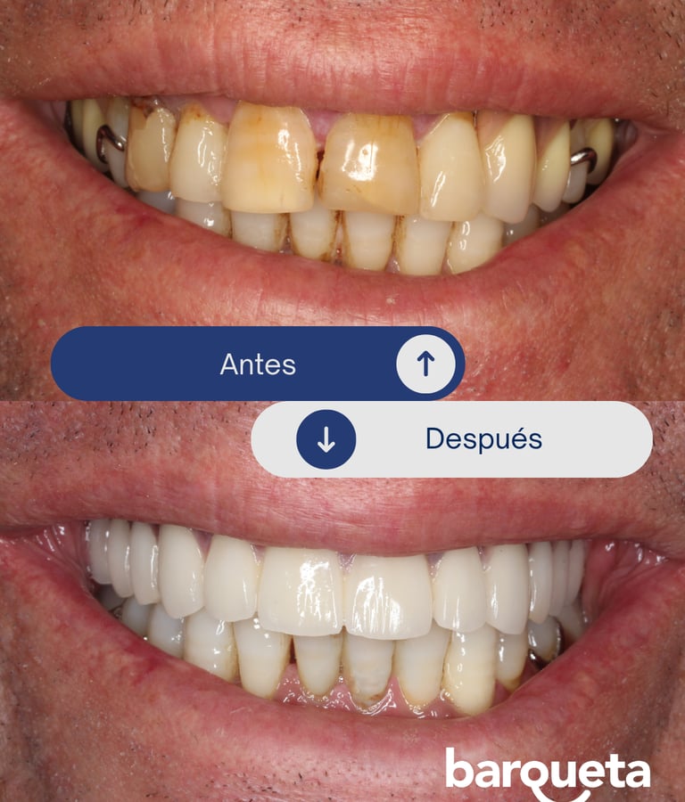 paciente satisfecho con sus carillas dentales