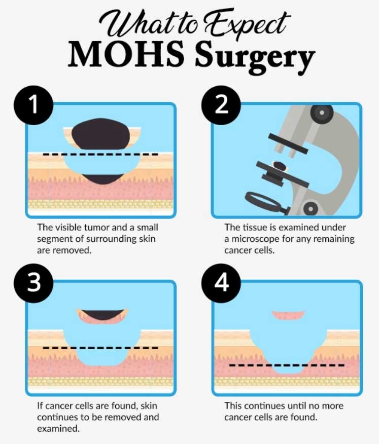 what to expect 4 steps about mohs surgery