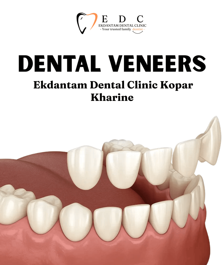 Veneers in Kopar Khairane | Ekdantam Dental Clinic kopar kharine