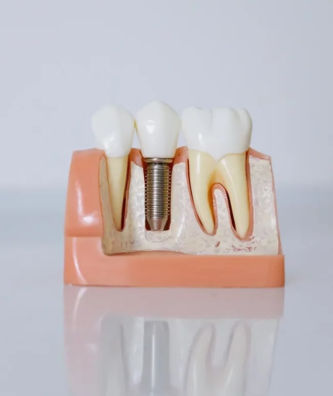 Implantes dentales en Sevilla