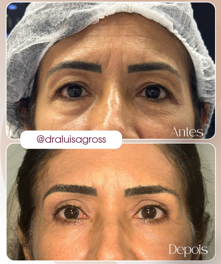 Antes e depois de cirurgia periocular realizada pela Dra. Luisa Gross