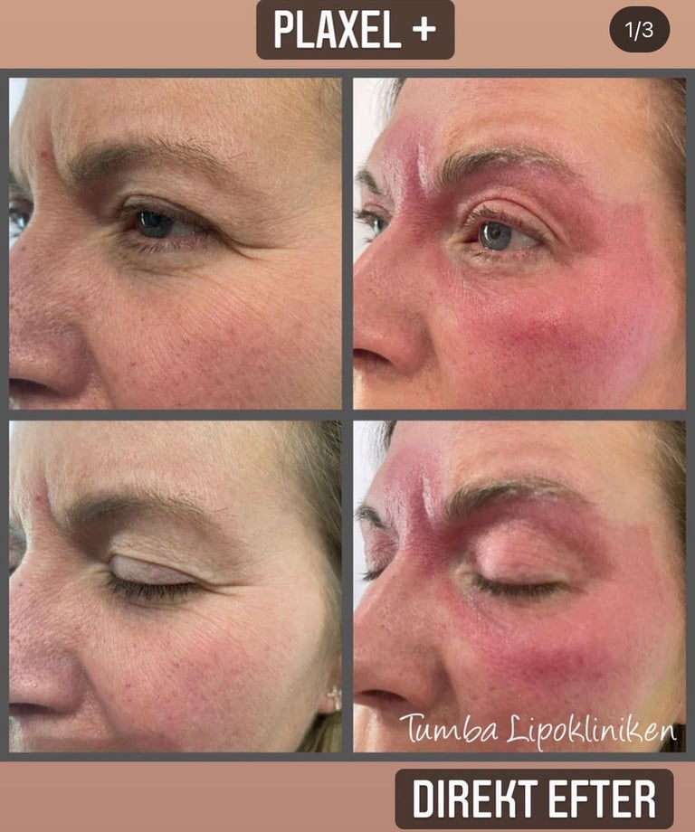 a person before and after plaxel plus