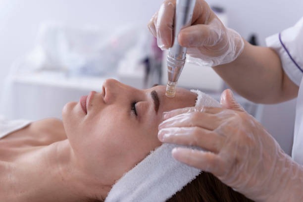 Ray Aesthetics microneedling procedure