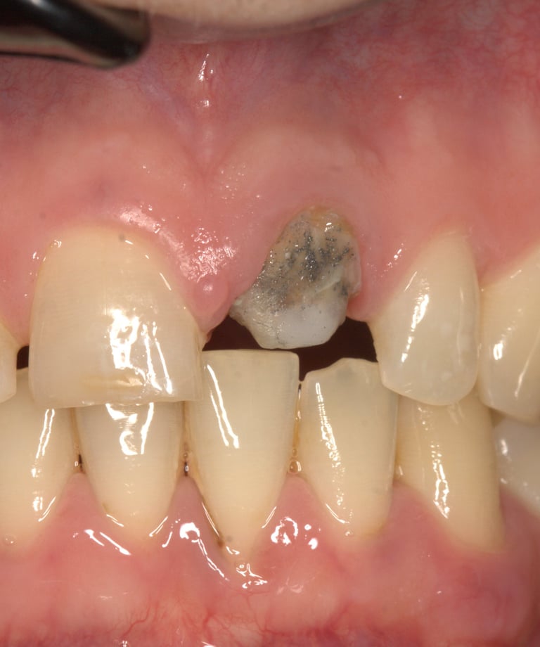 Preparazione Moncone Incongrua