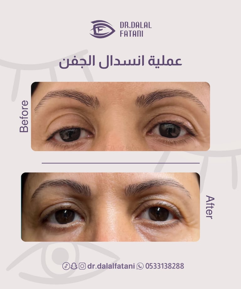 عملية انسدال الجفن