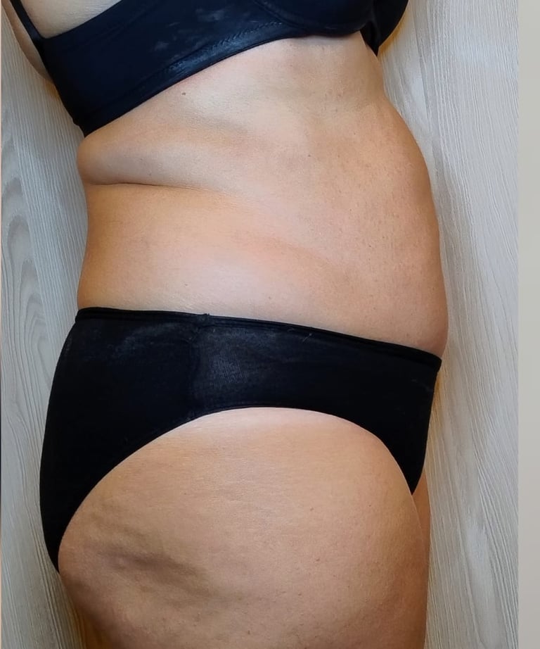 Fianchi e addome DOPO del Trattamento Lipolite Corpo