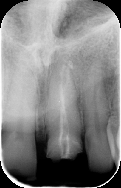 Trattamento Canalare Incongruo