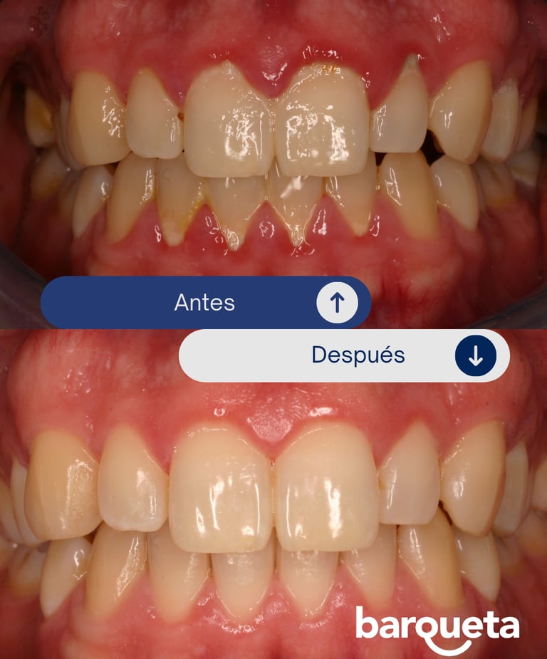 resultado tras tratamiento de periodoncia en sevilla