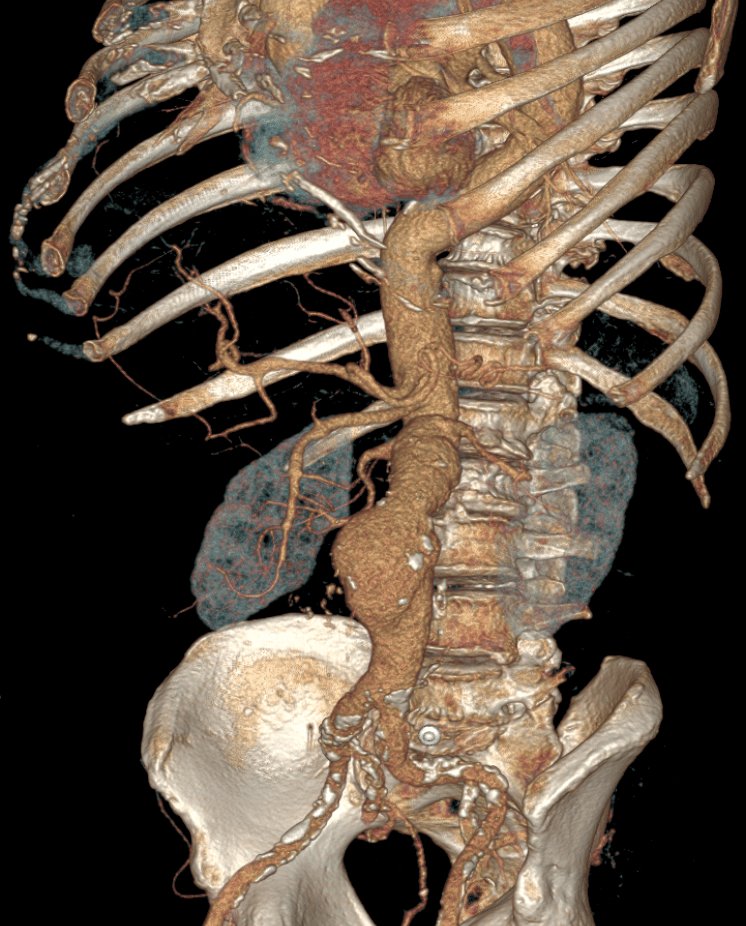 Anévrisme de l'aorte abdominale