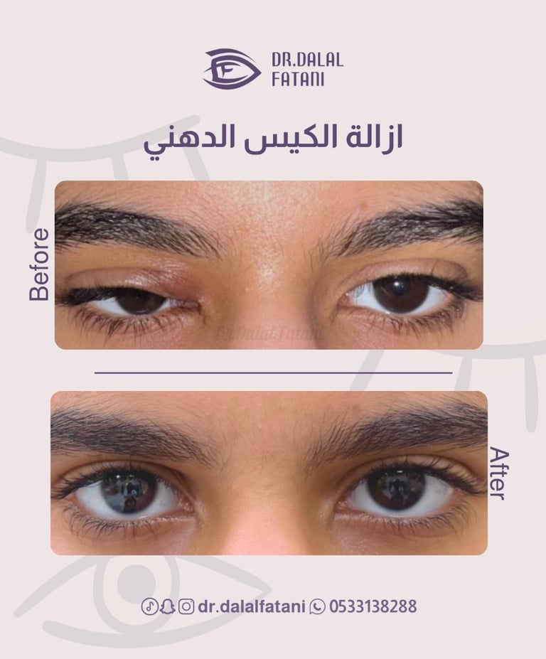 عملية ازالة كيس دهني من العين