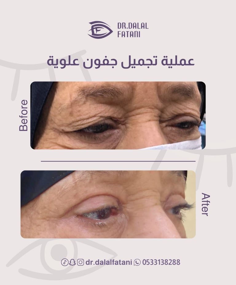 عملية تجميل جفون علوية