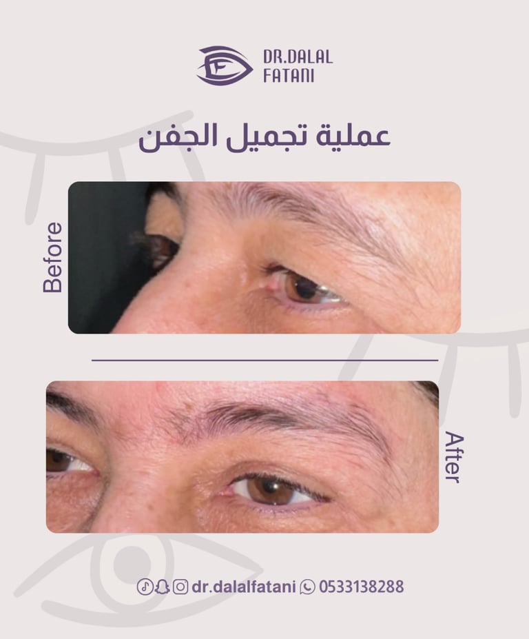 تجميل الجفن العلوي