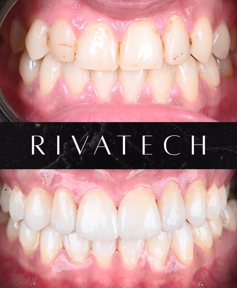 Dental veneers before and after transformation showing white, straight teeth for a smile makeover.