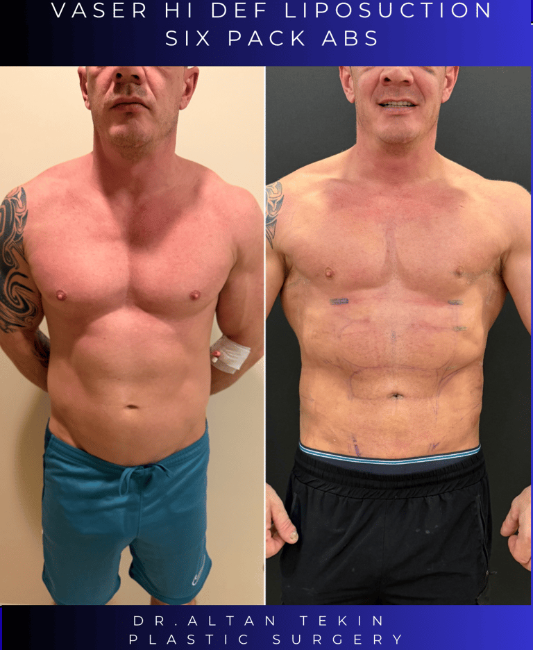 liposuction before after photos in Antalya, Turkey