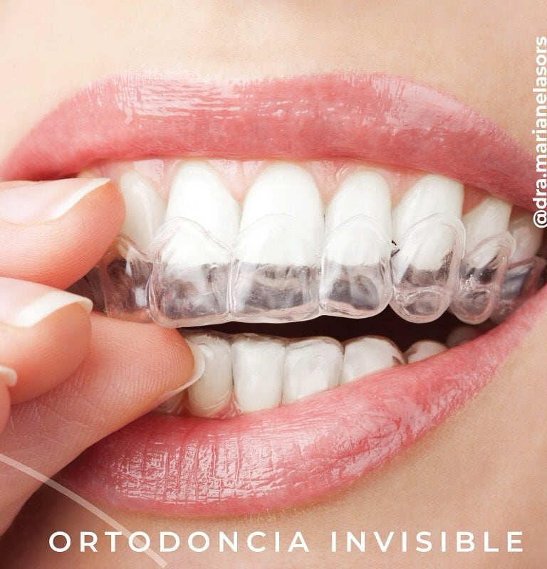 Alineadores invisibles para ortodoncia estética.  Ortodoncia invisible Dra Sors