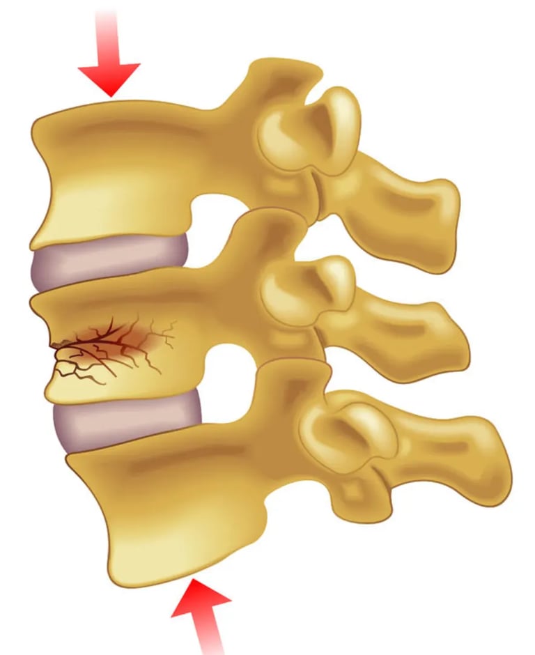 Dr.Rajinikanth's ortho clinic spine fracture