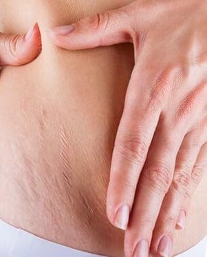 Peau harmonisée après camouflage des vergetures féminines.