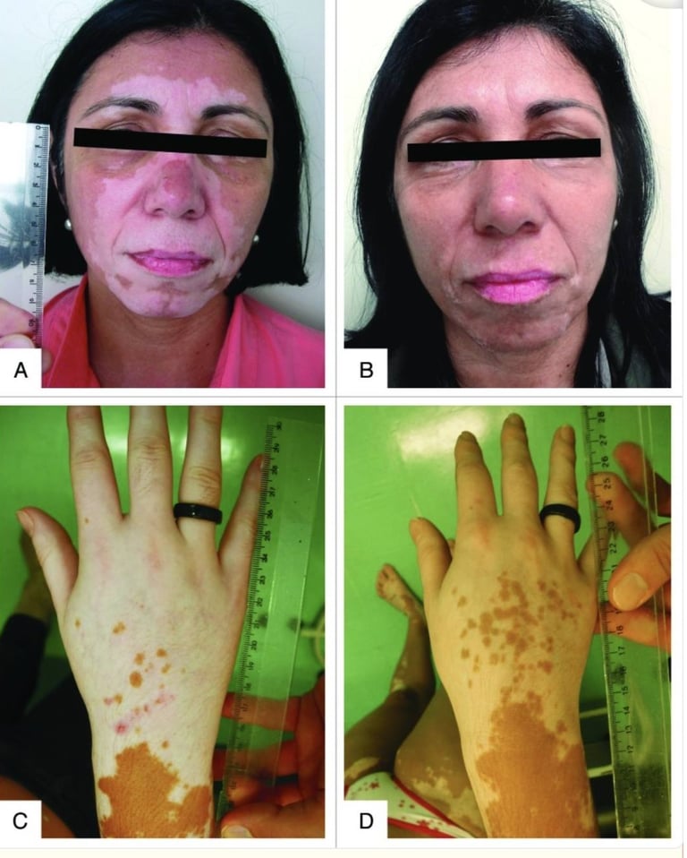 Tratamiento para vitiligo