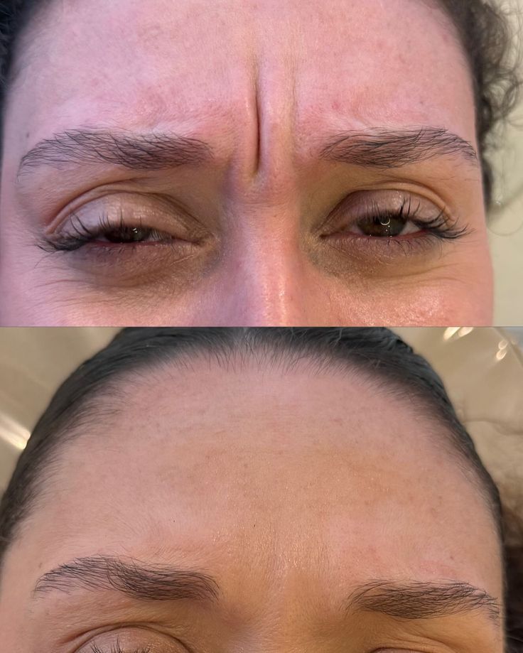 Botoks Ozawor mazowiecki