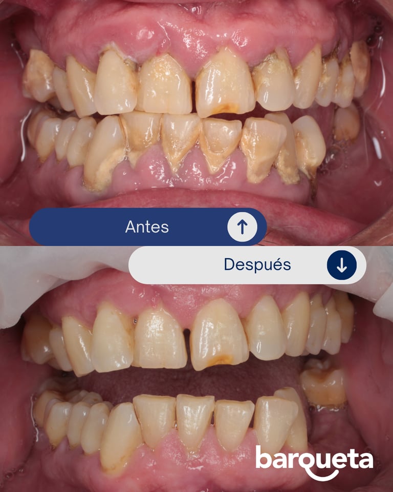 resultados de una limpieza dental profesional en sevilla