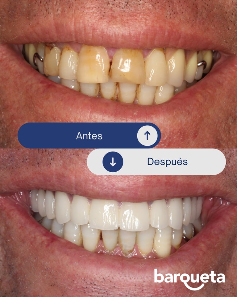 paciente satisfecho con sus carillas dentales