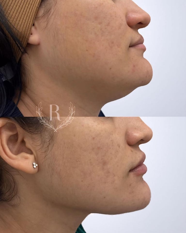 mesoterapia facial e corporal - clínica estética Tatuapé