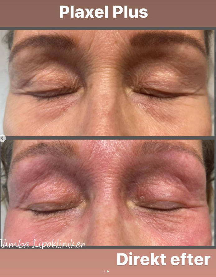 a person before and after plaxel plus