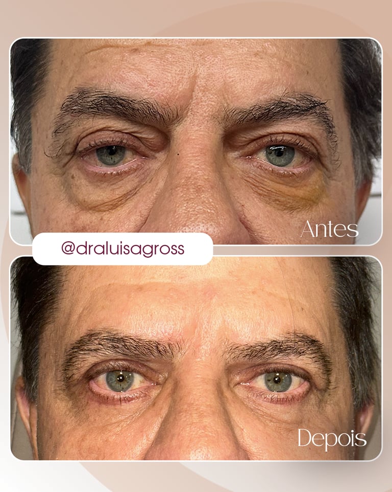 Antes e depois de cirurgia periocular realizada pela Dra. Luisa Gross