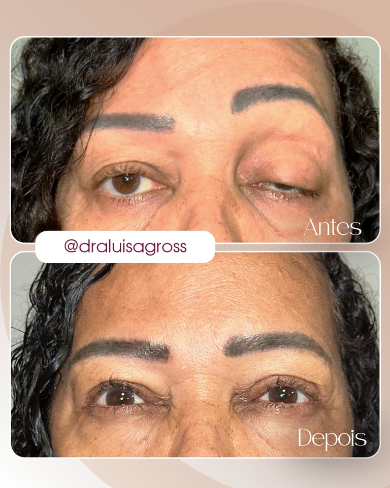 Antes e depois de cirurgia periocular realizada pela Dra. Luisa Gross