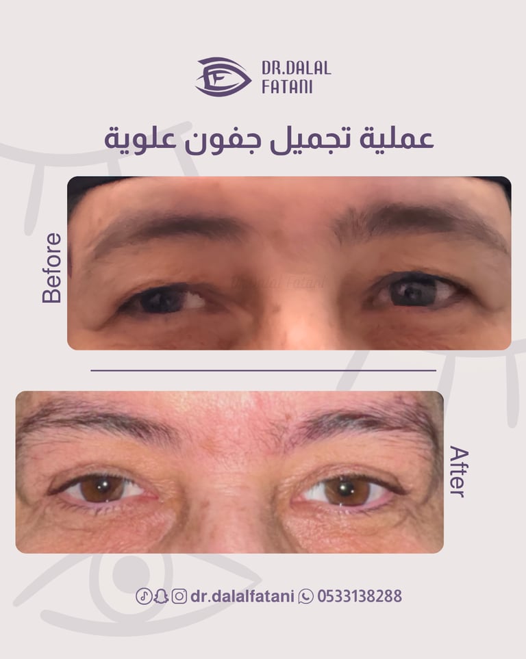 تجميل جفون علوية