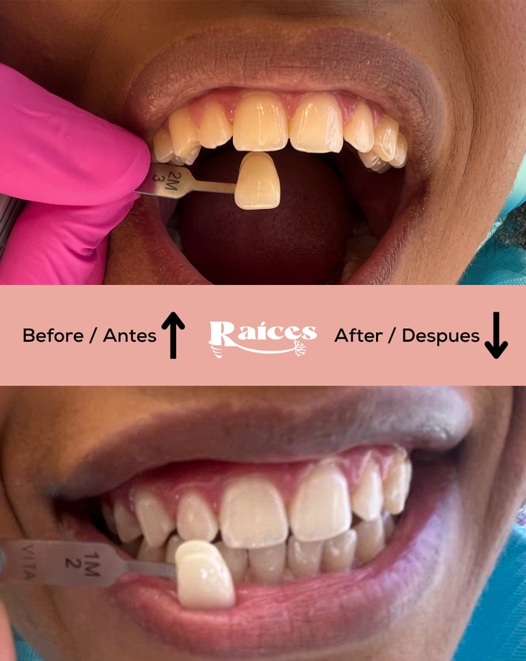 dental teeth whitening tenerife