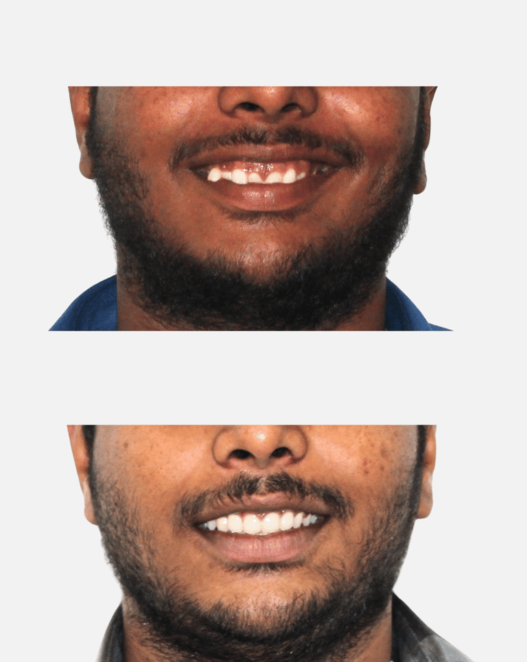 Invsialign Transformation