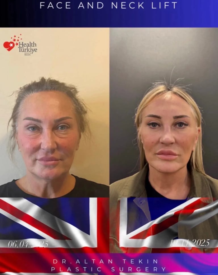 facelift before after