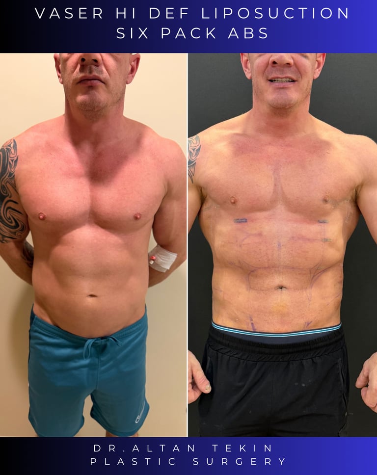 Before and after photos showing defined abdominal etching results on a patient.