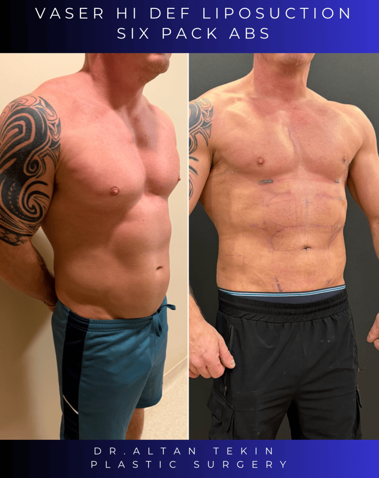 Before and after photos showing defined abdominal etching results on a patient.