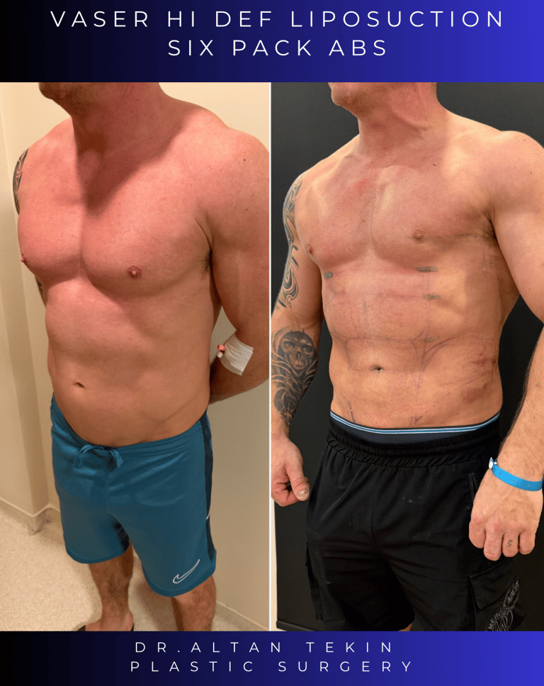 Before and after photos showing defined abdominal etching results on a patient.