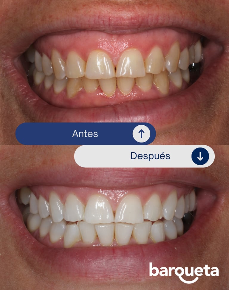 resultados naturales del blanqueamiento dental en sevilla