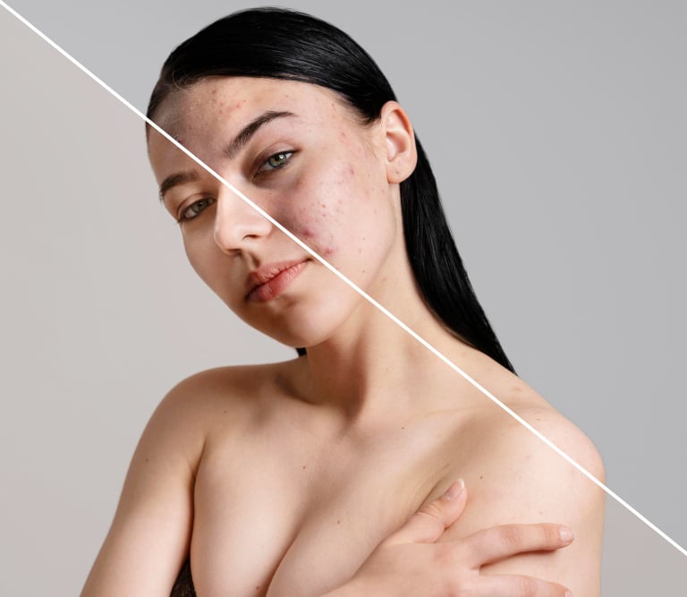 MIcroneedling skincare treatment comparison showing a woman's face with acne scars and clear skin.