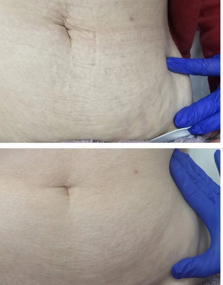 Significant improvement results in abdominal stretch mark treatments at Ariana Esthetic Edmonton.