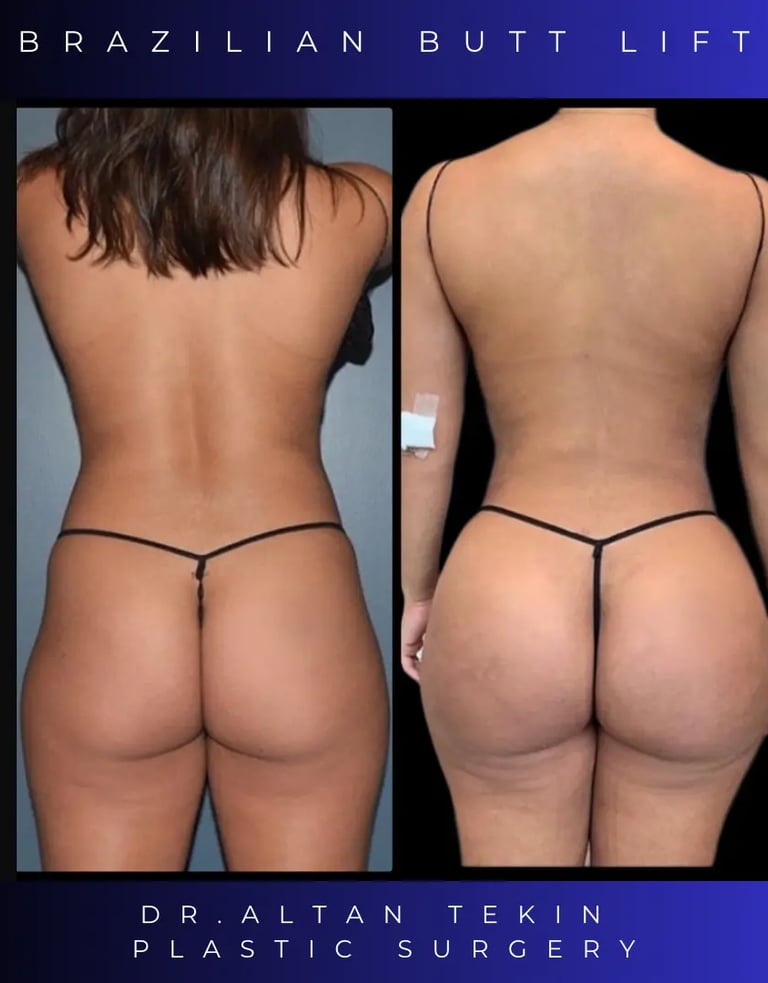 BBL before after photos in Antalya, Türkiye