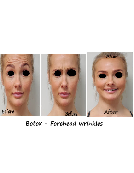 Botox in forehead and glabella before and after photo – reduced wrinkles and youthful appearance.